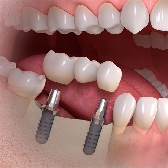 dental implant2