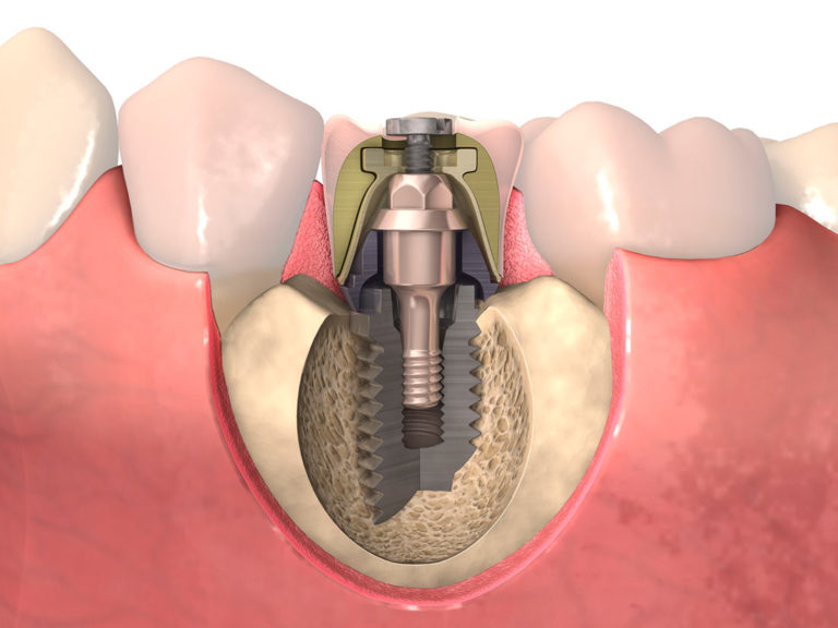 procedimiento-implante-dental-768x576